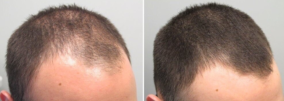 Befor and after hair transplant, KA Hair Solutions