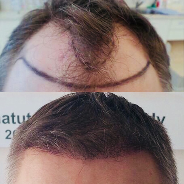 Mans head being prepared and mans head after hair transplant