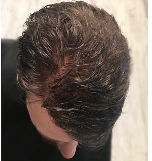Glue on Hair Replacement Systems, KA Hair Solutions