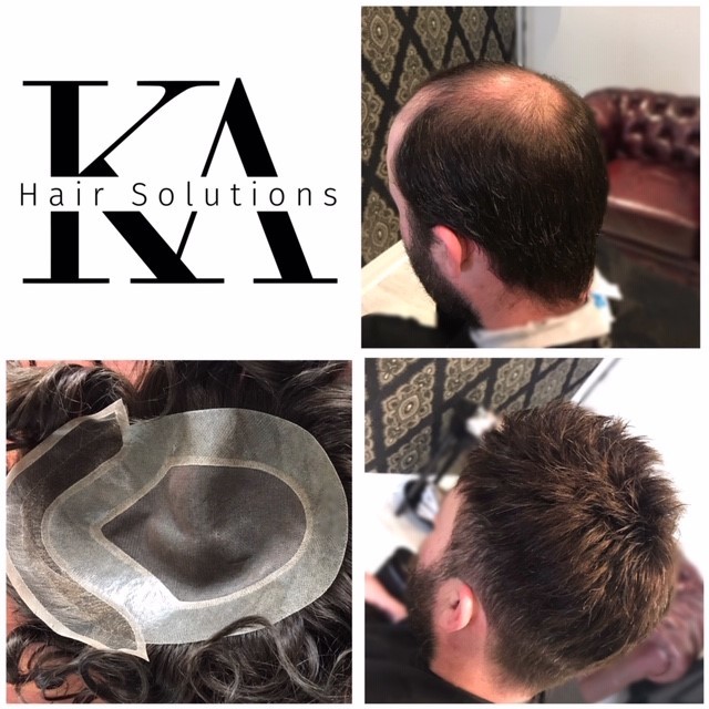 Providing the latest technology in Non-Surgical Hair Replacement