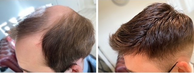 Hair replacement system made from real human hair