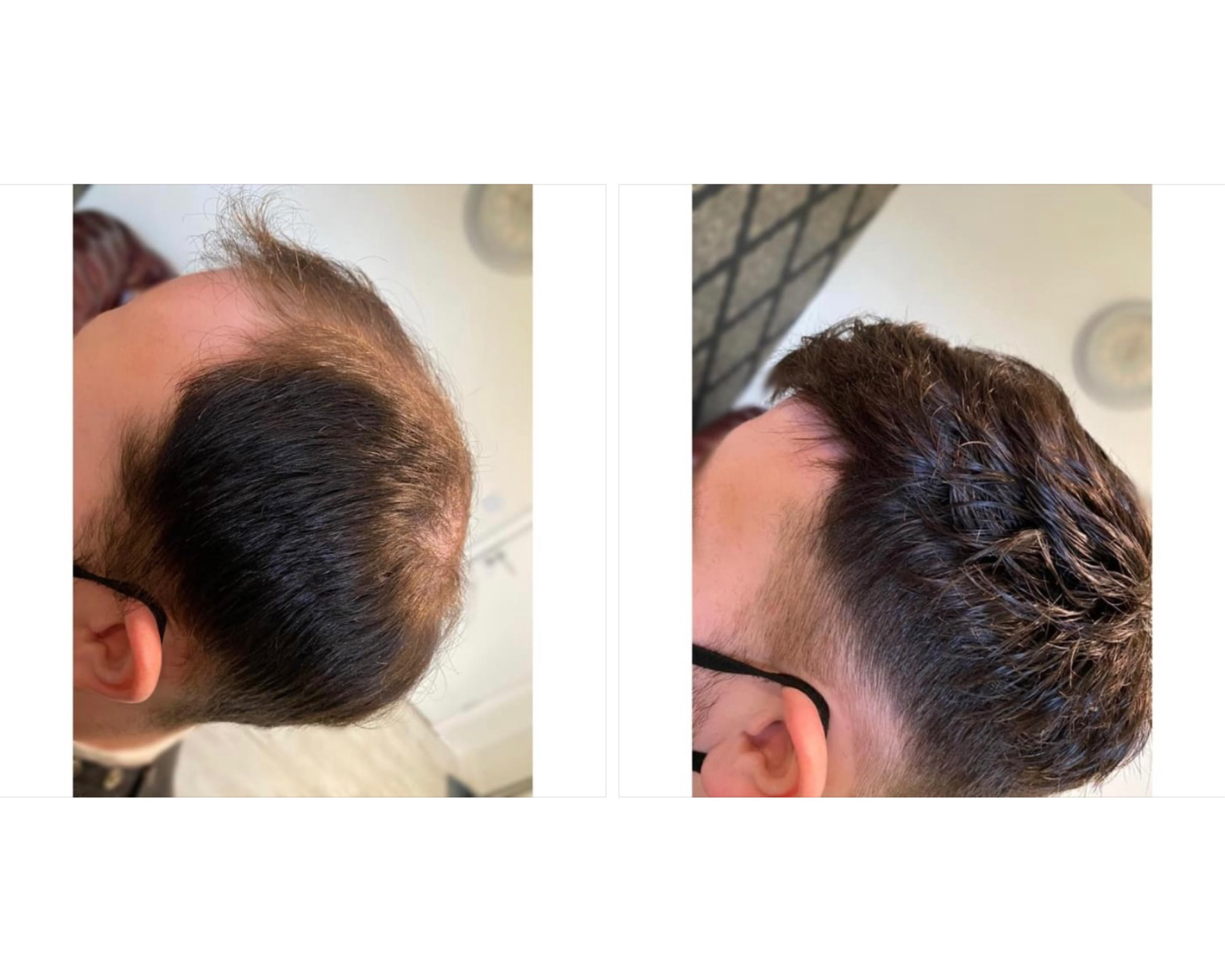Hair system for men - Before and After - KA Hair Solutions Dublin