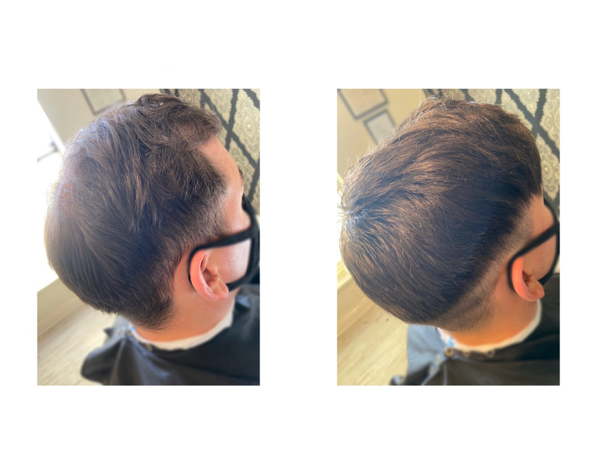 Hair system for men - Before and After - KA Hair Solutions Dublin